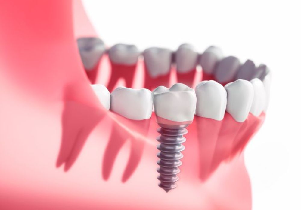 Quelles sont les missions proposées par les cliniques dédiées aux implants dentaires ?
