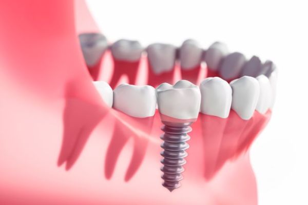 Quelles sont les missions proposées par les cliniques dédiées aux implants dentaires ?